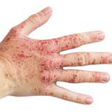 Allergik kontakt dermatit